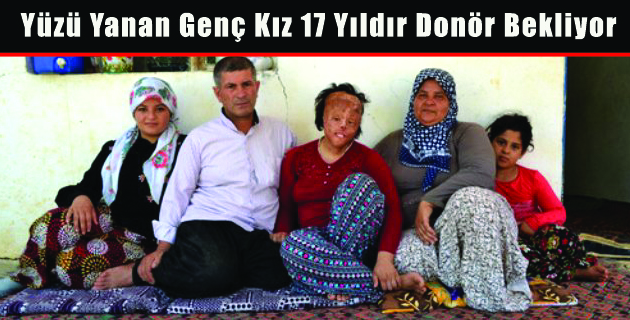 Yüzü Yanan Genç Kız 17 Yıldır Donör Bekliyor
