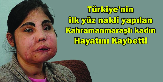 Türkiye’nin ilk yüz nakli yapılan Kahramanmaraşlı kadın öldü!